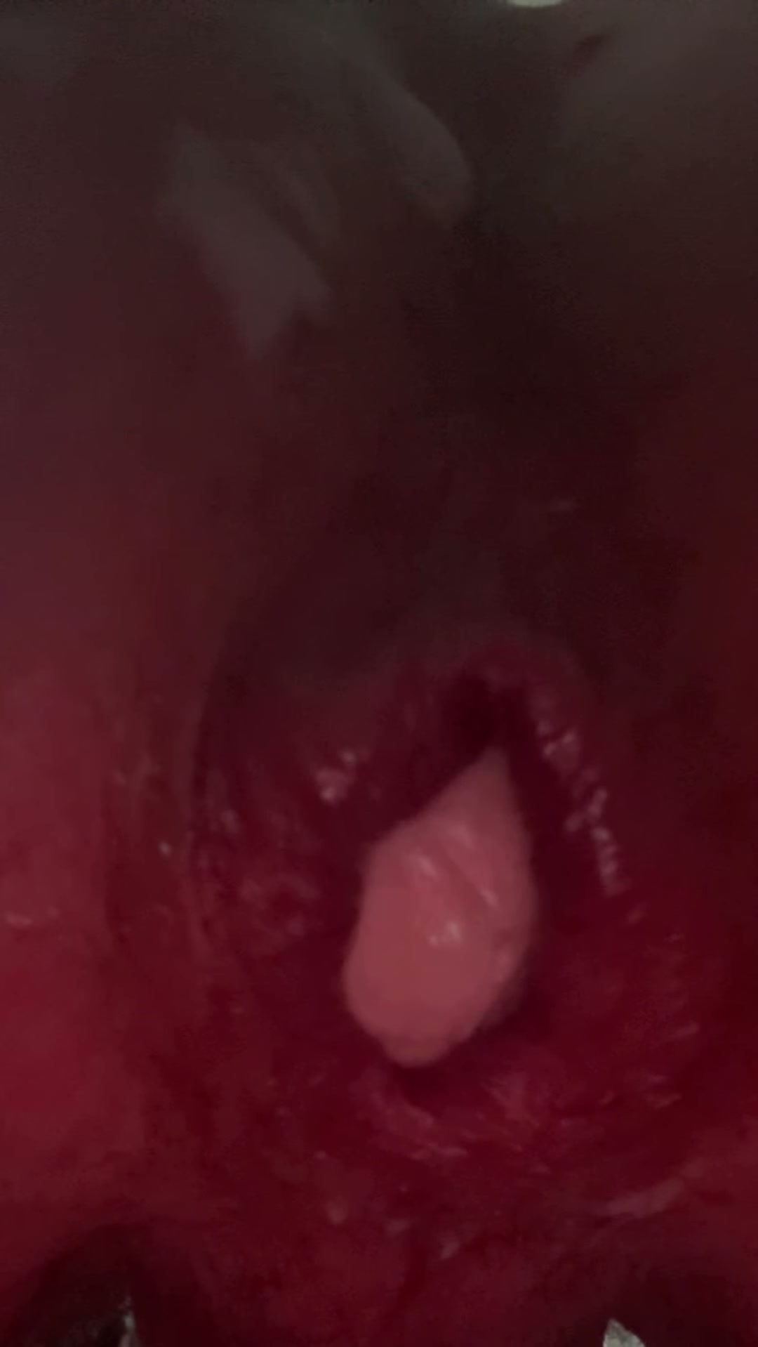 stress ball pushed out of my stretched hole